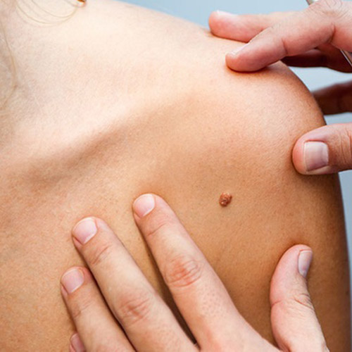 skin tag removal